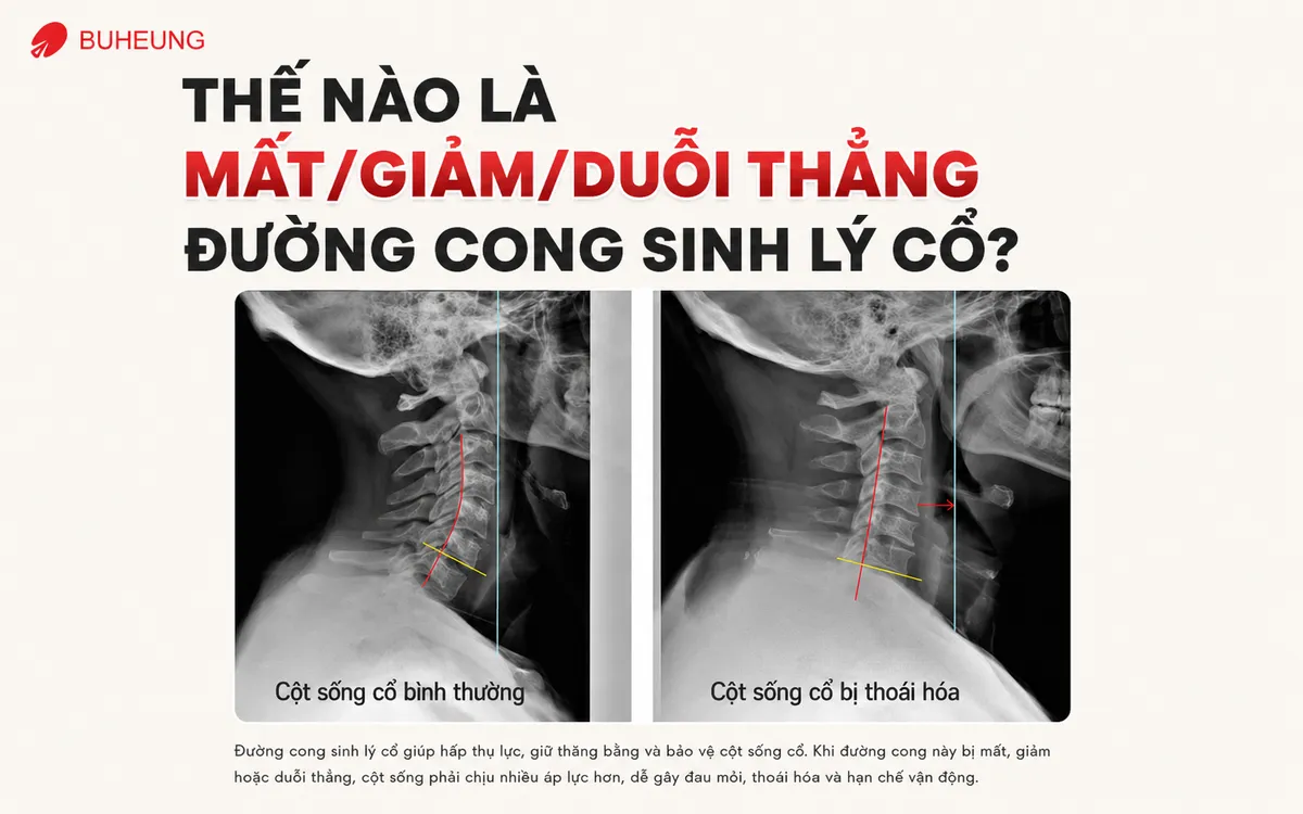 Giảm Đường Cong Sinh Lý Cổ: Nguyên Nhân, Triệu Chứng Và Giải Pháp Phục Hồi Hiệu Quả 2 So sánh phim X-quang cột sống cổ bình thường và cột sống cổ bị mất đường cong, minh họa duỗi thẳng đường cong sinh lý cổ.