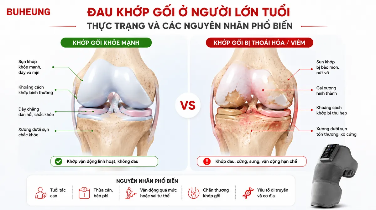 Sơ đồ minh họa cấu tạo khớp gối khỏe mạnh và khớp gối bị thoái hóa, chỉ rõ sụn khớp bị bào mòn và gai xương.